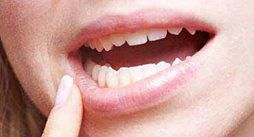 Diş apsesi nedir ve nasıl tedavi edilir?