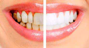 Diş Taşı Temizliği ve Beyazlatma İşlemi Arasında Ne Fark Var?